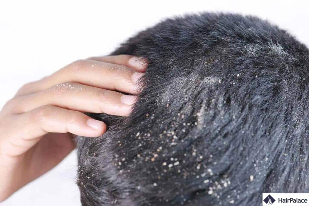 Les pellicules peuvent contribuer à la perte de cheveux en fragilisant le cuir chevelu et en provoquant des irritations