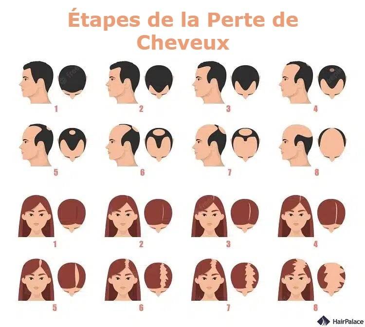 Les différentes étapes de la perte de cheveux chez les hommes et les femmes.