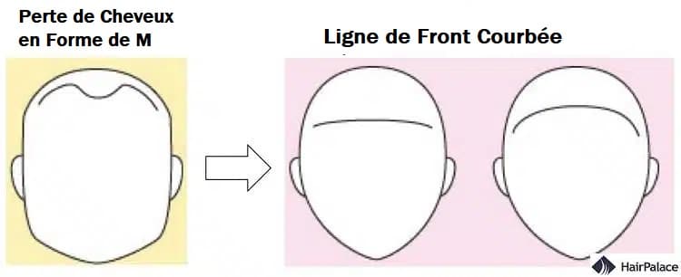 Différence entre la ligne d'implantation des cheveux d'un homme et d'une femme